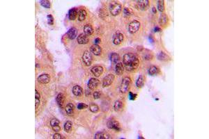 Immunohistochemical analysis of MKK4 (pT261) staining in human breast cancer formalin fixed paraffin embedded tissue section.