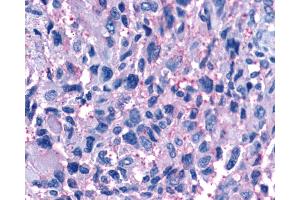 Anti-P2RY11 / P2Y11 antibody IHC of human Brain, Glioblastoma.