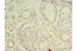 Immunohistochemistry of paraffin-embedded human breast cancer using ABIN7147697 at dilution of 1:100