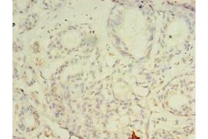 Immunohistochemistry of paraffin-embedded human breast cancer using ABIN7147697 at dilution of 1:100 (CBX2 anticorps  (AA 1-211))