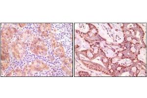 Immunohistochemical analysis of paraffin-embedded human ovary carcinoma (left) and breast carcinoma (right), showing cytoplasmic(ovary carcinoma) localization, cytoplasmic and nuclear (breast carcinoma) localization using SNCG antibody with DAB staining. (SNCG anticorps)