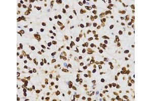 Immunohistochemistry of paraffin-embedded Human kidney cancer using DiMethyl-Histone H3-K27 Polyclonal Antibody at dilution of 1:200 (40x lens). (Histone 3 anticorps  (2meLys27))