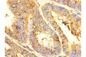 Immunohistochemistry of paraffin-embedded human endometrial cancer using ABIN7154164 at dilution of 1:100