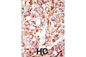 Formalin-fixed and paraffin-embedded human hepatocellular carcinoma tissue reacted with the ACSL3 polyclonal antibody  , which was peroxidase-conjugated to the secondary antibody, followed by DAB staining. (Acsl3 anticorps  (N-Term))