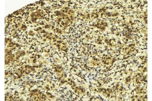 ABIN6272950 at 1/100 staining Human breast cancer tissue by IHC-P. (SPOP-B anticorps  (Internal Region))