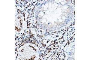 Immunohistochemistry of paraffin-embedded human colon carcinoma using PRKCB Rabbit pAb (ABIN6128462, ABIN6146199, ABIN6146201 and ABIN6217699) at dilution of 1:50 (40x lens).