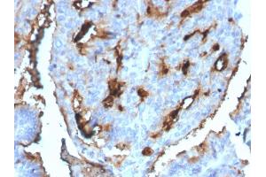 Formalin-fixed, paraffin-embedded human Breast Carcinoma stained with CDC34 Mouse Monoclonal Antibody (CPTC-CDC34-2).