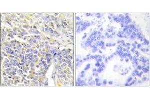 Immunohistochemistry analysis of paraffin-embedded human lung carcinoma tissue, using KAD1 Antibody . (Adenylate Kinase 1 anticorps  (AA 101-150))