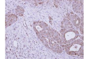 IHC-P Image Immunohistochemical analysis of paraffin-embedded NCI-N87 xenograft, using GALNS, antibody at 1:100 dilution.