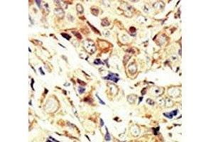 IHC analysis of FFPE human breast carcinoma tissue stained with the IGF1R antibody