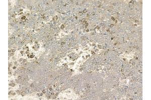ABIN6256036 and ABIN6267166 at 1/100 staining human melanoma by IHC-P.