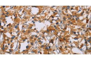 Immunohistochemistry of paraffin-embedded Human thyroid cancer tissue using NRN1 Polyclonal Antibody at dilution of 1:40 (NRN1 anticorps)