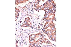 Immunohistochemistry of paraffin-embedded Human colon carcinoma using [KO Validated] IFITM3 Rabbit pAb (ABIN6130482, ABIN6142186, ABIN6142187 and ABIN7101416) at dilution of 1:100 (40x lens). (IFITM3 anticorps  (AA 1-133))