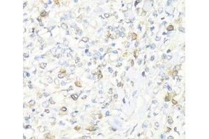 Immunohistochemistry of paraffin-embedded Human gastric cancer using EIF3J Polyclonal Antibody at dilution of 1:100 (40x lens). (EIF3S1 anticorps)