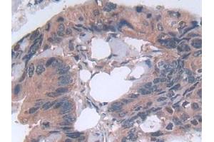 Detection of MMP23B in Human Colorectal cancer Tissue using Polyclonal Antibody to Matrix Metalloproteinase 23B (MMP23B) (MMP23B anticorps  (AA 79-390))