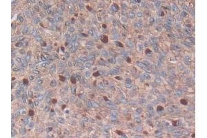 DAB staining on IHC-P; Samples: Human Skin cancer Tissue (S100A14 anticorps  (AA 1-91))