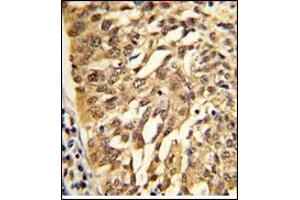 AP17730PU-N SAR1A Antibody (Center) staining of Formalin-Fixed, Paraffin-Embedded Human lung carcinoma. (SAR1A anticorps  (Middle Region))