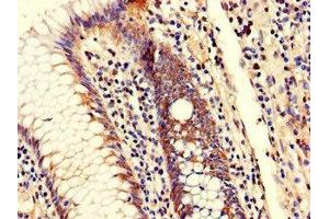 Immunohistochemistry of paraffin-embedded human colon cancer using ABIN7151322 at dilution of 1:100
