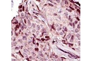 IHC analysis of FFPE human breast carcinoma tissue stained with the IRAK4 antibody (IRAK4 anticorps  (AA 5-36))
