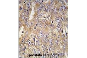 Formalin-fixed and paraffin-embedded human prostata carcinoma tissue reacted with LTBP1 antibody (C-term) (ABIN392207 and ABIN2841907) , which was peroxidase-conjugated to the secondary antibody, followed by DAB staining. (LTBP1 anticorps  (C-Term))