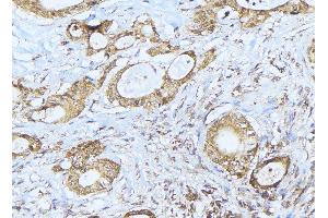 ABIN6275239 at 1/100 staining Human lung cancer tissue by IHC-P. (MRPS36 anticorps)