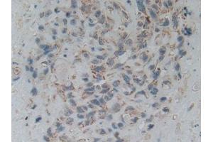 Detection of SMAD5 in Human Lung cancer Tissue using Polyclonal Antibody to SMAD family member 5 (SMAD5)