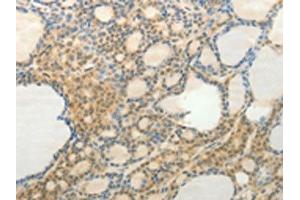 The image on the left is immunohistochemistry of paraffin-embedded Human thyroid cancer tissue using ABIN7192532(SLC9A3 Antibody) at dilution 1/20, on the right is treated with synthetic peptide. (SLC9A3 anticorps)