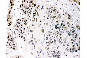 IHC-P staining of human oesophagus squama cancer tissue (p300 anticorps  (AA 2065-2414))