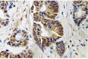 Immunohistochemistry (IHC) analyzes of GRK 2 antibody in paraffin-embedded human colon carcinoma tissue. (GRK2 anticorps)