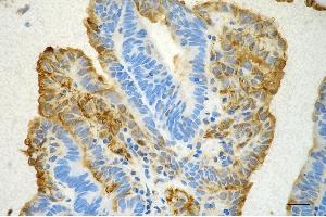 Immunohistochemistry was performed on paraffin-embedded human endometrial carcinoma using annexin A1 antibody (ABIN7797614), 1:200). (Recombinant Annexin a1 anticorps)