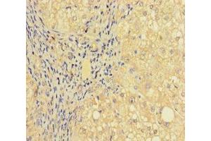Immunohistochemistry of paraffin-embedded human liver cancer using ABIN7164277 at dilution of 1:100 (PRICKLE4 anticorps  (AA 1-240))
