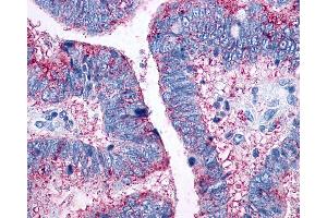 Anti-CCR10 / GPR2 antibody IHC of human Colon, Carcinoma.