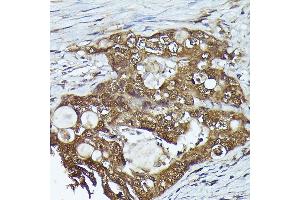 Immunohistochemistry of paraffin-embedded human colon carcinoma using FERMT2 Rabbit pAb (ABIN6131926, ABIN6140582, ABIN6140583 and ABIN6224757) at dilution of 1:300 (40x lens).