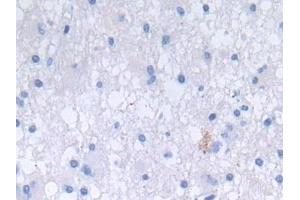 Detection of DEFa3 in Human Glioma Tissue using Polyclonal Antibody to Defensin Alpha 3, Neutrophil Specific (DEFa3)