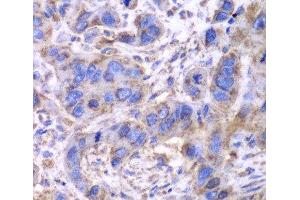 Immunohistochemistry of paraffin-embedded Human esophageal cancer using SDHA Polyclonal Antibody at dilution of 1:100 (40x lens).