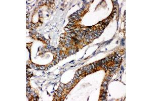 Anti-Laminin gamma 1 antibody, IHC(P) IHC(P): Human Intestinal Cancer Tissue (Laminin gamma 1 anticorps  (C-Term))