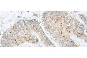 Immunohistochemistry of paraffin-embedded Human colorectal cancer tissue using MLNR Polyclonal Antibody at dilution of 1:35(x200) (Motilin Receptor anticorps)