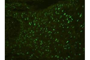 IF analysis of PHF21A using anti-PHF21A antibody (ABIN6719353) PHF21A was detected in paraffin-embedded section of human oesophagus squama cancer tissues. (PHF21A anticorps  (AA 1-97))