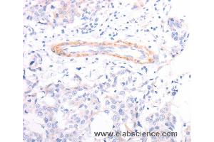 Immunohistochemistry of Human breast cancer using TPM1 Polyclonal Antibody at dilution of 1:40 (Tropomyosin anticorps)