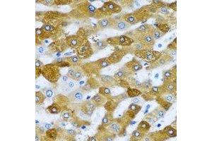 Immunohistochemical analysis of RPL9 staining in human liver cancer formalin fixed paraffin embedded tissue section.