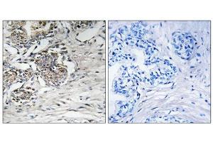 Immunohistochemistry analysis of paraffin-embedded human prostate carcinoma tissue using Claudin 7 (epitope around residue 210) antibody. (Claudin 7 anticorps  (Tyr210))