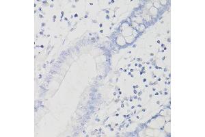 Immunohistochemistry of paraffin-embedded Human intestinal adenocarcinoma (negative control samples) using PD-L1/CD274/CD274 Rabbit mAb (ABIN7266181) at dilution of 1:200 (40x lens). (PD-L1 anticorps  (Extracellular Domain))