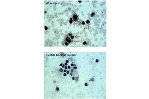 ADORA3 antibody staining of Oral Cell Carcinoma at a dilution of 5 ug/ml (Adenosine A3 Receptor anticorps  (C-Term))