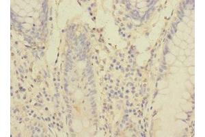 Immunohistochemistry of paraffin-embedded human colon cancer using ABIN7166553 at dilution of 1:100