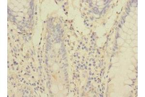 Immunohistochemistry of paraffin-embedded human colon cancer using ABIN7166553 at dilution of 1:100 (Protocadherin 1 anticorps  (AA 60-220))
