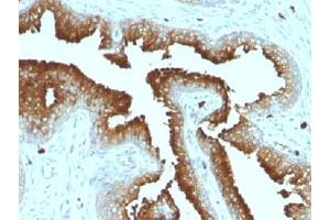IHC testing of FFPE prostate carcinoma with CD63 antibody.