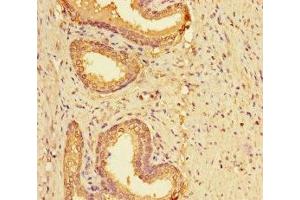 Immunohistochemistry of paraffin-embedded human prostate cancer using ABIN7158595 at dilution of 1:100