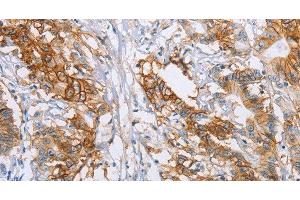 Immunohistochemistry of paraffin-embedded Human colon cancer tissue using CA9 Polyclonal Antibody at dilution 1:50 (CA9 anticorps)