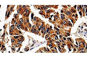 Immunohistochemistry of paraffin-embedded Human lung cancer tissue using IL13RA1 Polyclonal Antibody at dilution 1:50