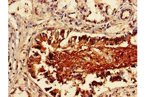 Immunohistochemistry of paraffin-embedded human lung cancer using ABIN7158291 at dilution of 1:100 (LAIR1 anticorps  (AA 22-165))